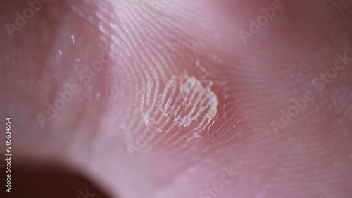 Callosity on man's palm extreme close up photo