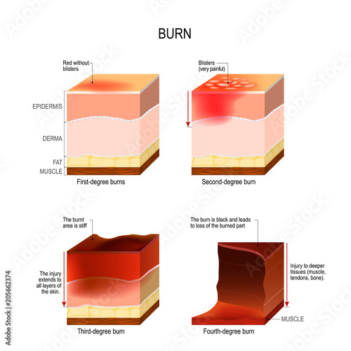 skin burn. four degrees of burns. photo