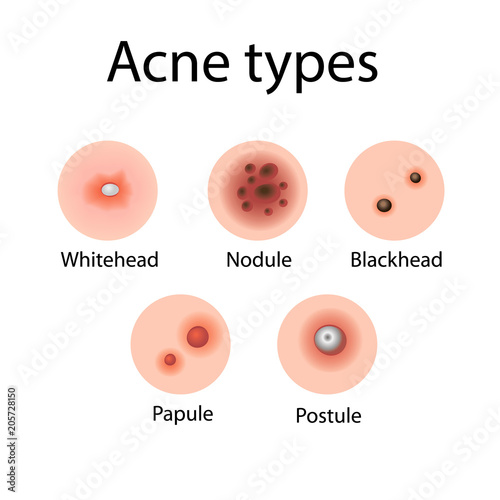 Acne types vector illustration. Cosmetology. Derma problems