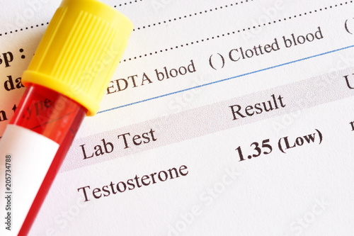 Abnormal low testosterone hormone test result with blood sample tube photo