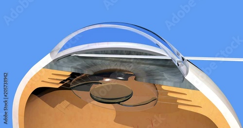 glaucoma surgery, reestablished natural aqueous humor outflow in human eye after ab interno trabeculotomy, 4K, 3d render, cg animation on blue background photo