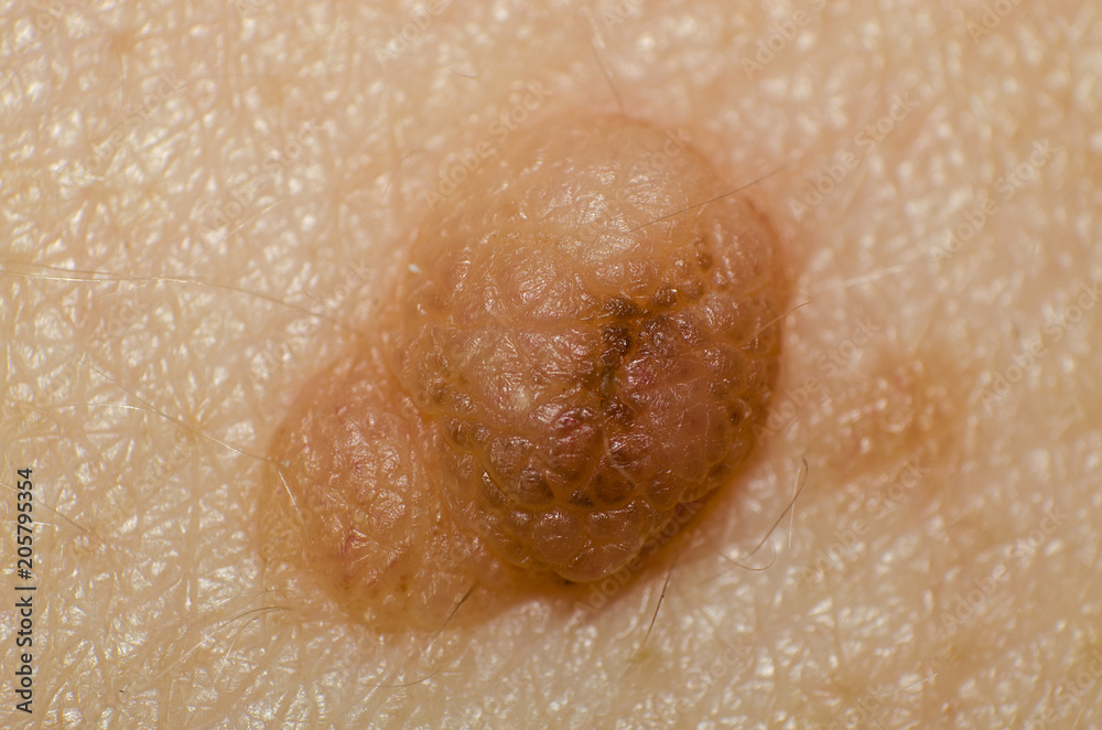 Fototapeta premium Birthmark or papilloma on the skin and body of a person closeup