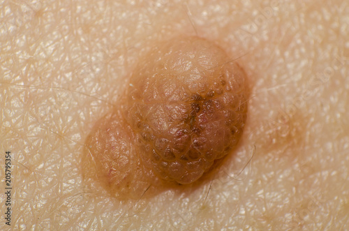 Birthmark or papilloma on the skin and body of a person closeup