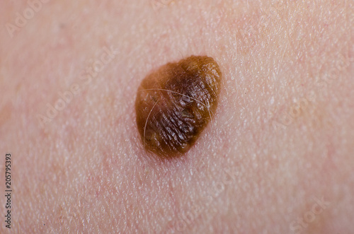 Birthmark or papilloma or Keratopapilloma on human skin closeup