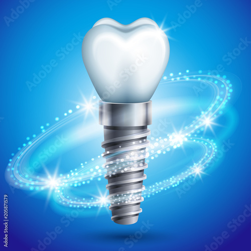 Vector illustration - dental implant icon