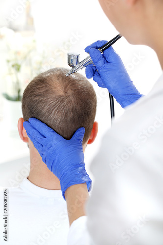 Tlenoterapia przeciw wypadaniu włosów. Głowa mężczyzny z przerzedzonymi włosami podczas zabiegu pielęgnacyjnego