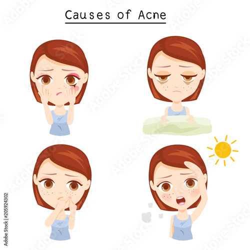 Causes of Acne