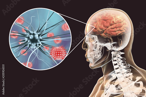 Viral meningitis and encephalitis, medical concept, 3D illustration showing brain infection and close-up view of viruses in the brain photo