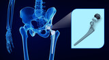 Hip replacement implant installed in the pelvis bone. X-ray view. Medically accurate 3D illustration