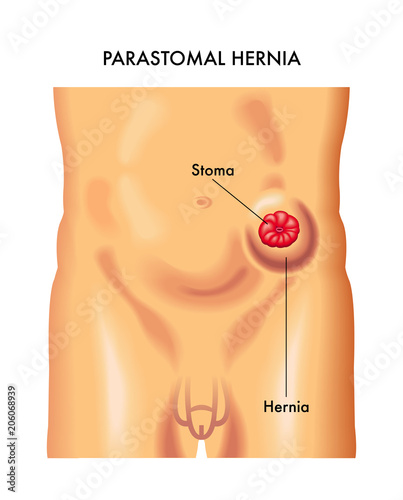 vector medical illustration of the symptoms of parastomal hernia