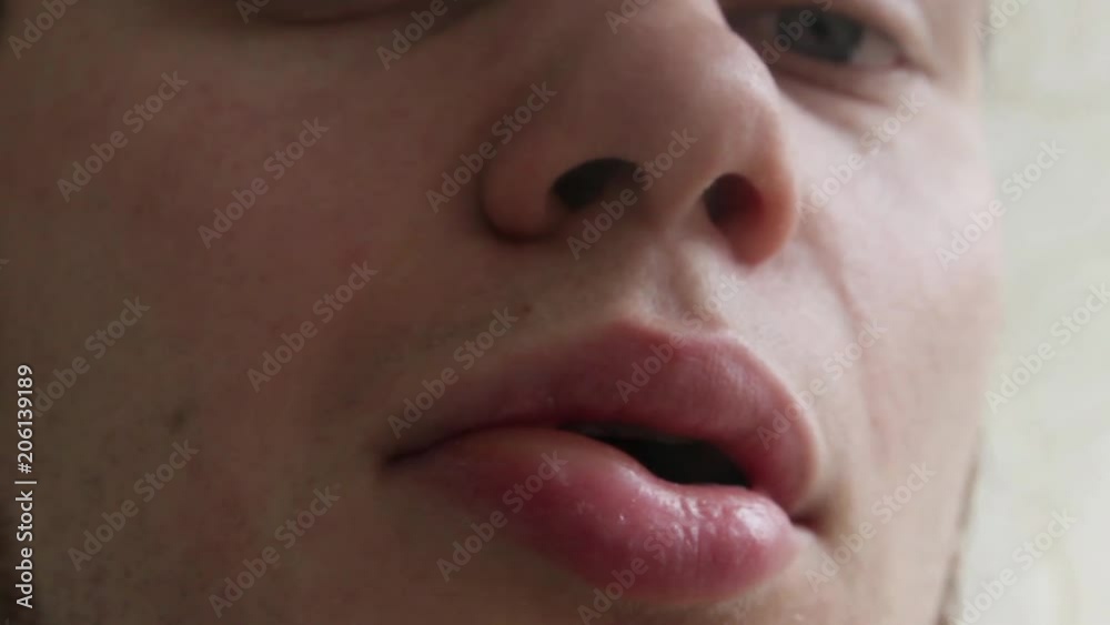 angioedema. Allergic reaction to the lip. Hives angioedema. Allergic reaction to the lip. Hives