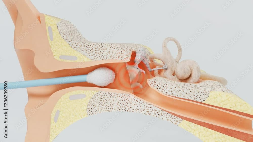 Inaccurate movement of cotton swab tears the eardrum. Hearing loss due the hearing membrane rupture. Inaccurate movement of cotton swab tears the eardrum. Hearing loss due the hearing membrane rupture.