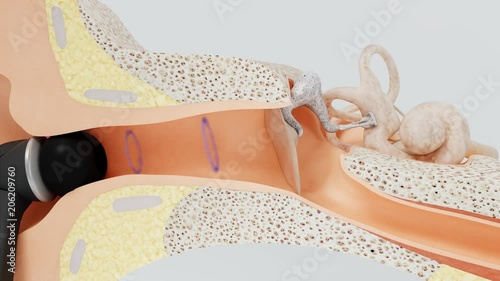 Loud sound from vacuum headphones damage the inner ear. Hearing loss.