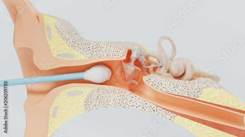 Inaccurate movement of cotton swab tears the eardrum. Hearing loss due the hearing membrane rupture.