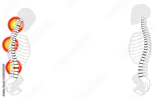 Back problems, neck aches, slipped disc prolapses - curved back with severe pain and healthy back in comparison - isolated vector illustration on white background.