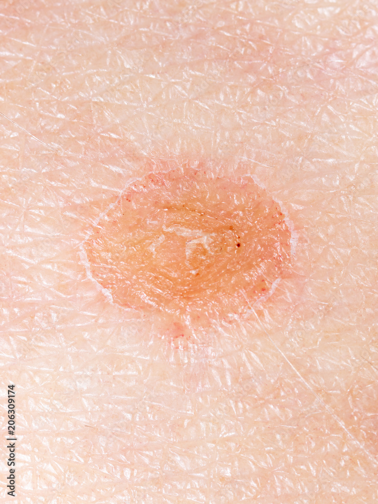 Fototapeta premium Ringworm on the human skin as a background