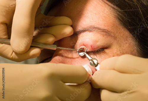 Healthcare concept - Chalazion during eye examination and operation photo