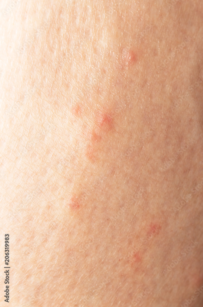 mosquito bites on the leg mosquito bites on the leg