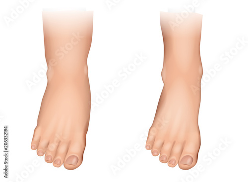 Vector illustration of edema on feet. 
Swelling of the feet and ankles. photo