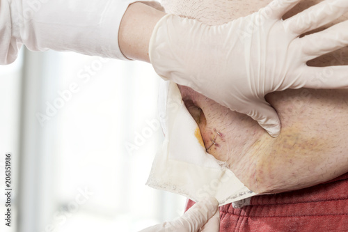 Nurse removing old gauze from patient's wound photo