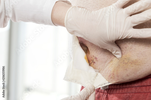 фотографія Nurse removing old gauze from patient's wound
