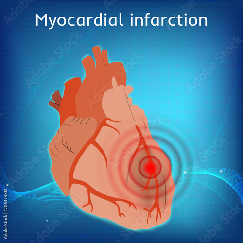 Myocardial infarction. Heart attack, pain. Damaged heart muscle. Anatomy flat illustration. Red image. Blue science background.