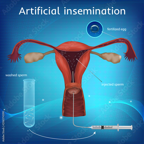 Artificial insemination. The fertilized egg, washed, injected sperm, uterus, womb, syringe. Anatomy illustration. Blue science background.