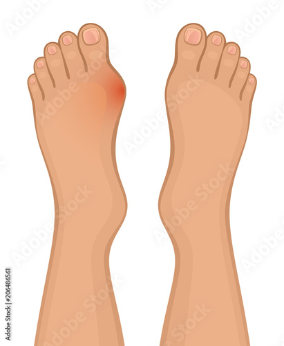 Foot disease on a white background