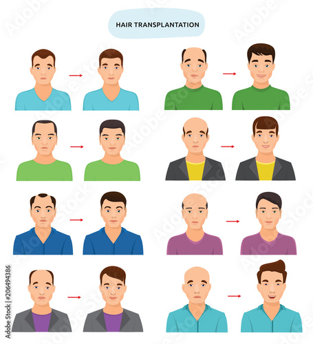Hair transplant vector hairy transplantation after hairloss and baldness for bald man illustration set of hairless male character and haired person with haircat isolated on white background