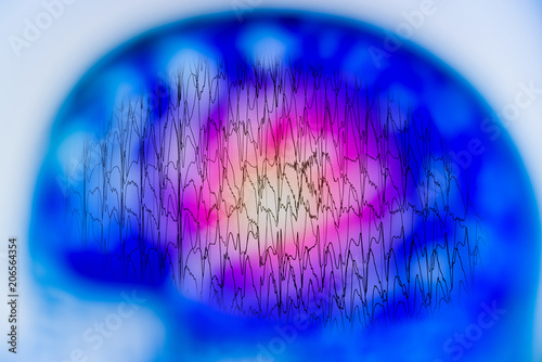 Abnormal EEG  brain wave