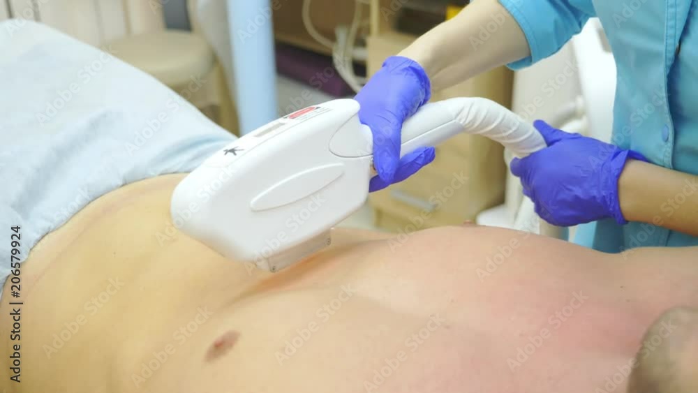 male laser hair removal. a doctor in gloves removes hair from the abdomen and breasts of a man. 4k, close-up.
