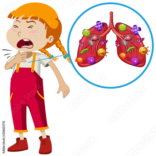A Vector of Girl Lung Infection