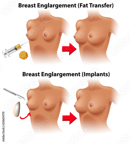 A Vector of Breast Surgery