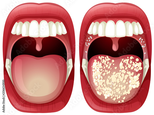 Vector of Healthy and Virus Mouth