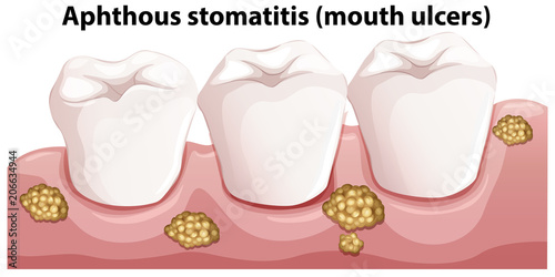 Human Anatomy of Aphthous Stomatitis