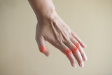 close up hand rheumatoid arthritis pateint.