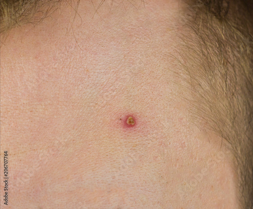 Red pimple on the forehead of a man, close-up