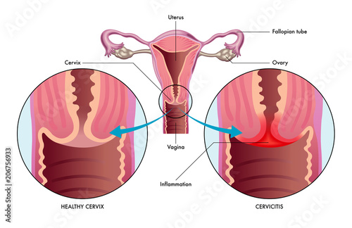 vector medical illustration of the condition cervicitis showing healthy cervix versus one with inflammation photo