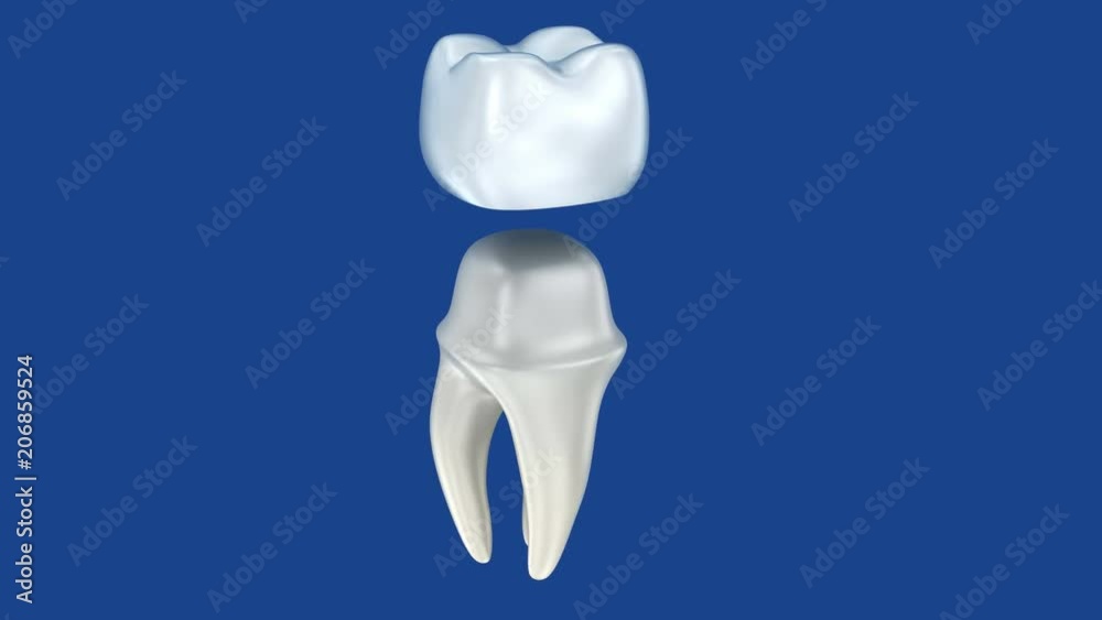 Dental crowns and tooth, 3d Concept animation Dental crowns and tooth, 3d Concept animation