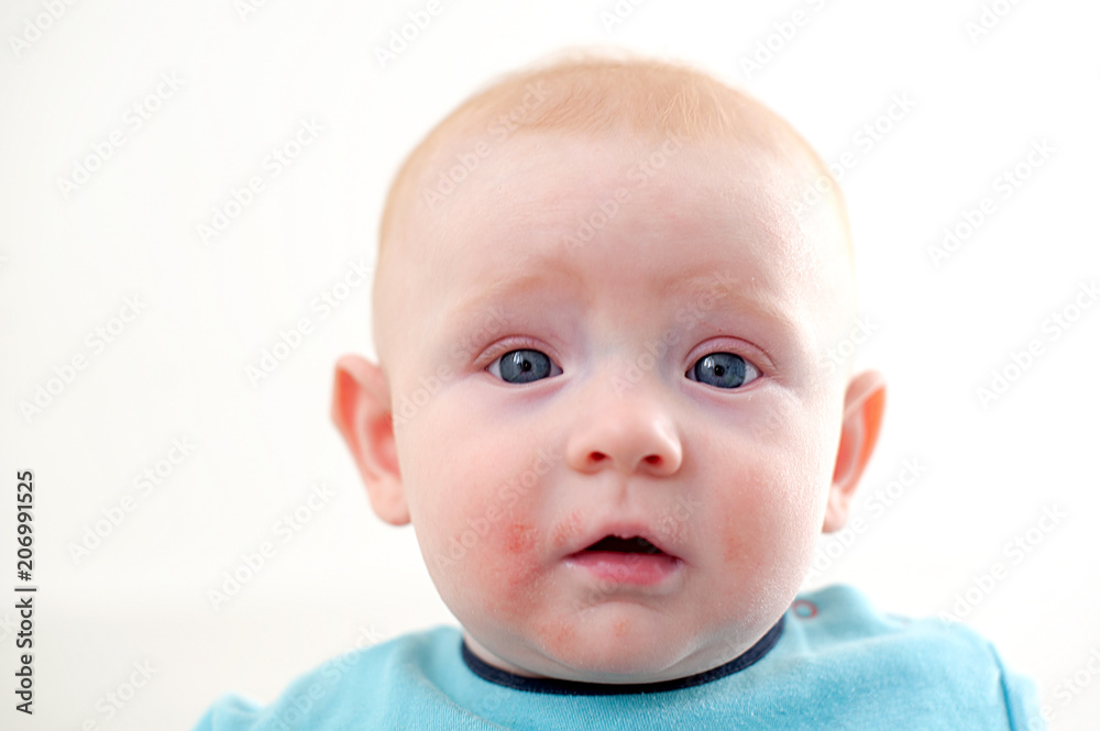 Allergies, atopic dermatitis on the face of a baby Allergies, atopic dermatitis on the face of a baby