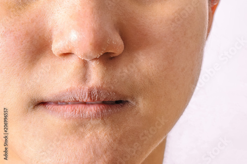 Obraz na plátne Allergic women have eczema dry nose and lips on winter season closeup