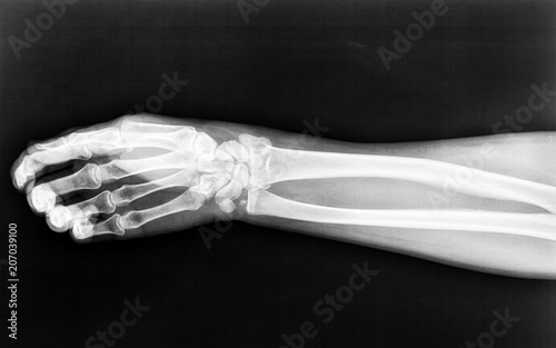 Fractures to the radius born of the right arm on an X-ray
