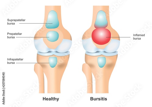Healthy Knee vs Bursitis Illustration