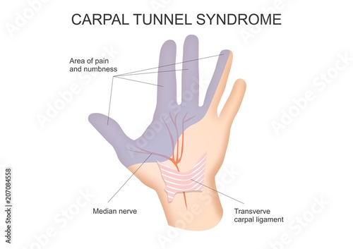 Carpal Tunnel Syndrome Diagram