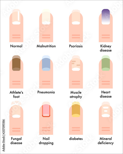 Types of diseases that appear on the nails vector flat graphic design illustration set