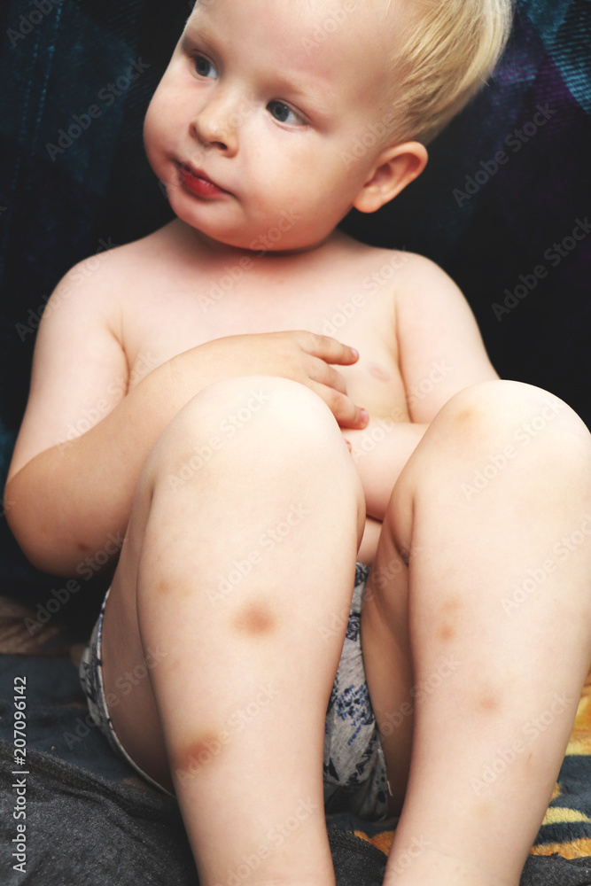 Bruises on the legs of the boy Bruises on the legs of the boy