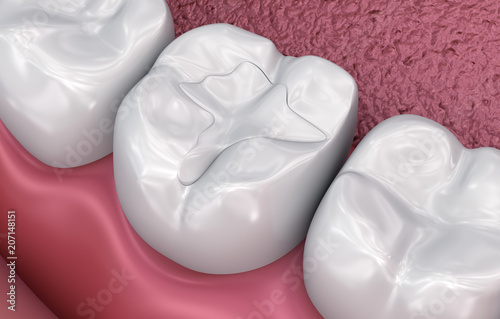 Dental fissure fillings, Medically accurate 3D illustration photo