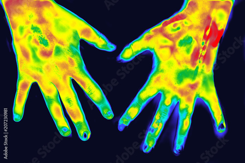 Thermography in medicine photo