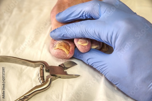 Podology, cutting skins. Professional pedicure in the hospita photo