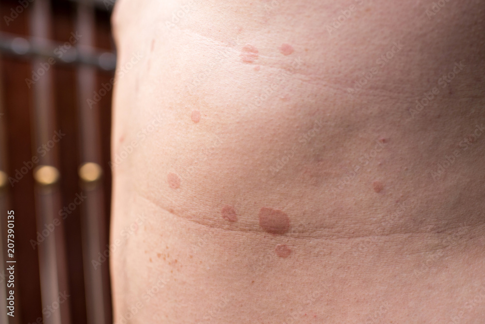 Ringworm on the body Ringworm on the body